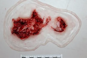 ForensicFX Studios Dog Bite Wound Prosthetic> Halloween Accessories