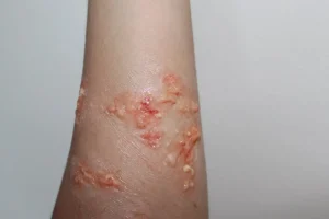 ForensicFX Studios Infected Blisters / Boils Prosthetic> Halloween Accessories