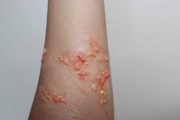 ForensicFX Studios Infected Blisters / Boils Prosthetic> Halloween Accessories