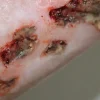 ForensicFX Studios Infected Wound / Burn Prosthetic> Halloween Accessories