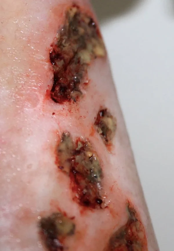 ForensicFX Studios Infected/Burn Wound Prosthetics Bundle> Halloween Accessories