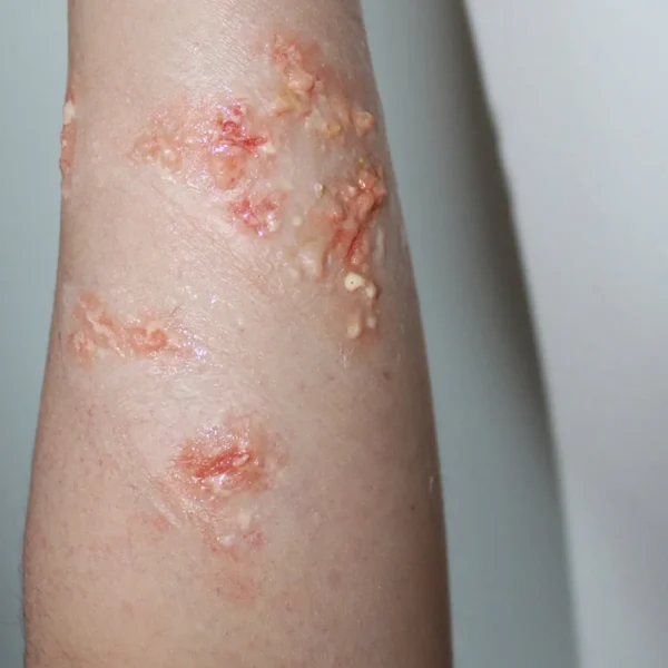 ForensicFX Studios Infected/Burn Wound Prosthetics Bundle> Halloween Accessories