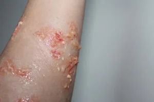 ForensicFX Studios Infected/Burn Wound Prosthetics Bundle> Halloween Accessories