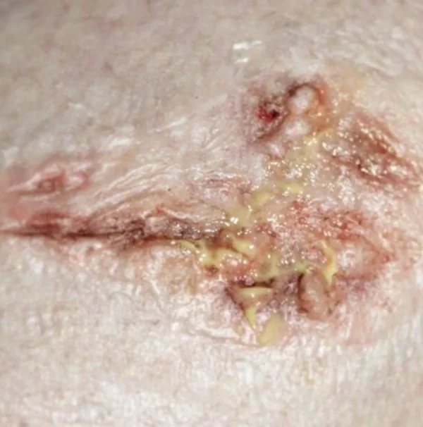ForensicFX Studios Infected/Burn Wound Prosthetics Bundle> Halloween Accessories