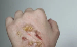 ForensicFX Studios Infected/Burn Wound Prosthetics Bundle> Halloween Accessories