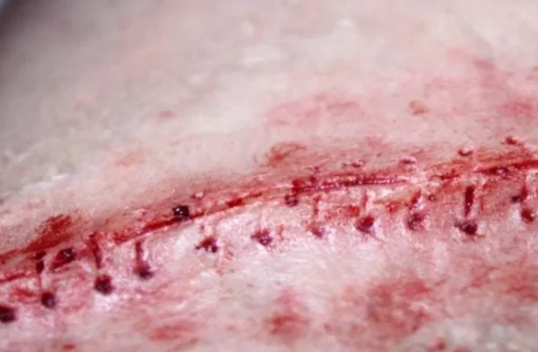 ForensicFX Studios Opened Stitches Prosthetic> Halloween Accessories
