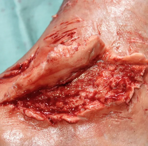 ForensicFX Studios Skin Peeling Back Wound Prosthetic> Halloween Accessories