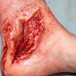 ForensicFX Studios Skin Peeling Back Wound Prosthetic> Halloween Accessories