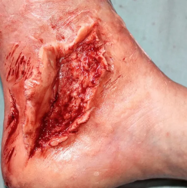 ForensicFX Studios Skin Peeling Back Wound Prosthetic> Halloween Accessories