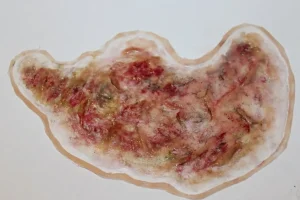 ForensicFX Studios Zombie Face Burn Prosthetic> Halloween Accessories